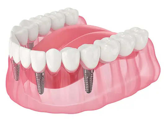 4 Implant Supported Dentures- All Michigan Implants