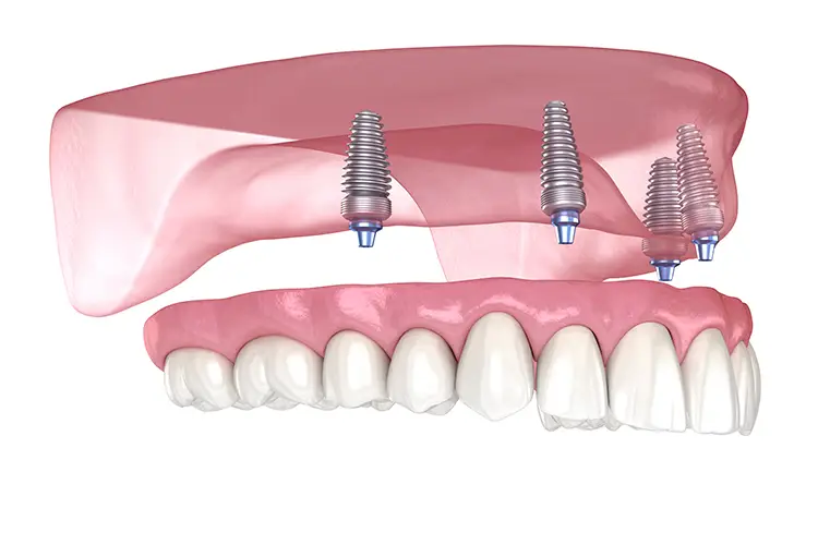 Say Goodbye to Loose Dentures with All-on-4