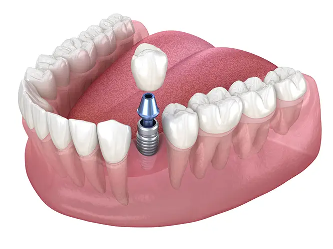 Dental Implants- All Michigan Implants