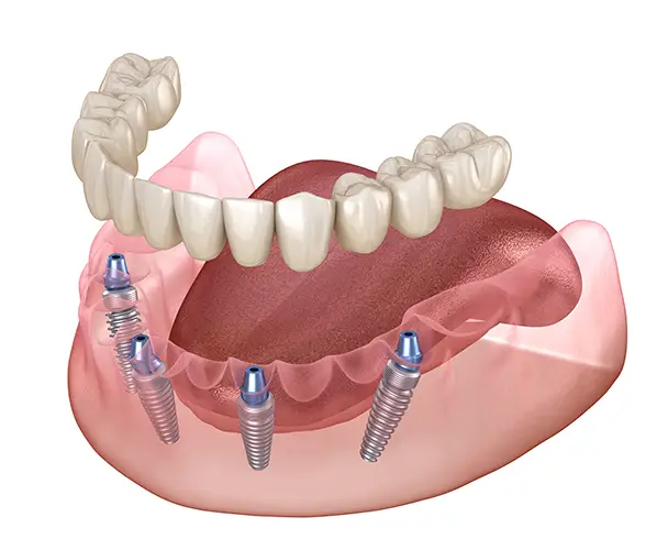 Permanent Teeth- All Michigan Implants