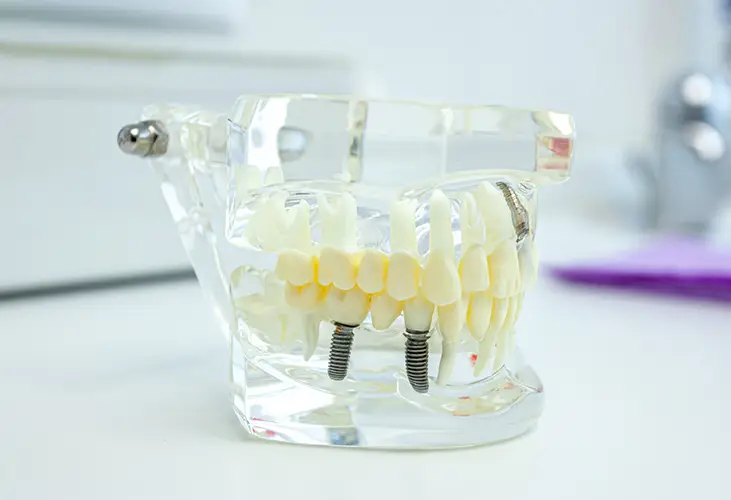 Smile Confidently with Dental Implants